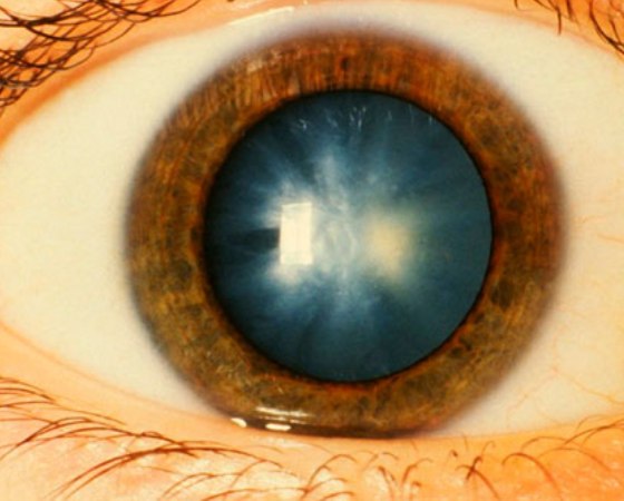 causes-cataracts