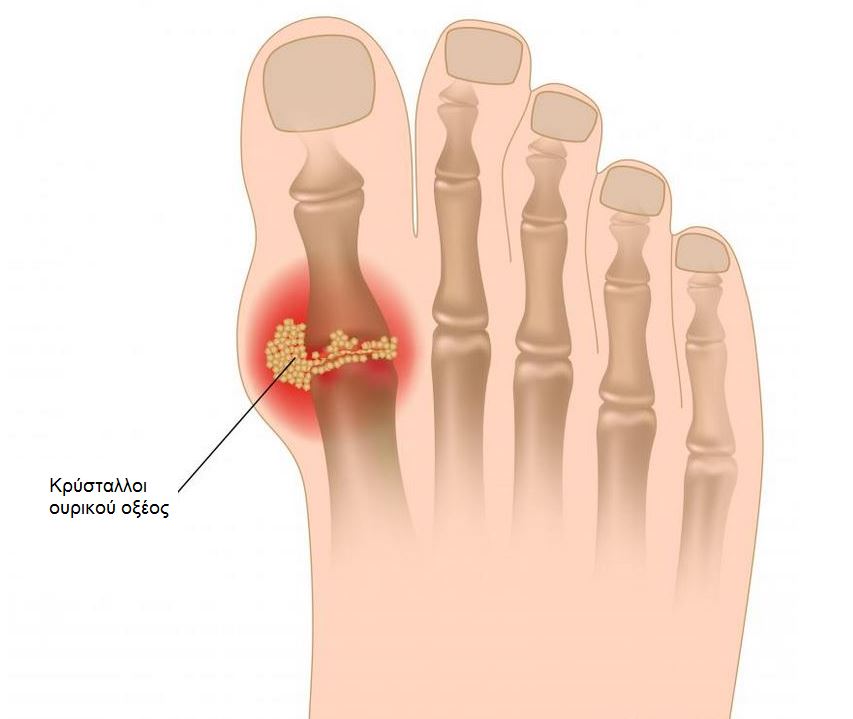 gout